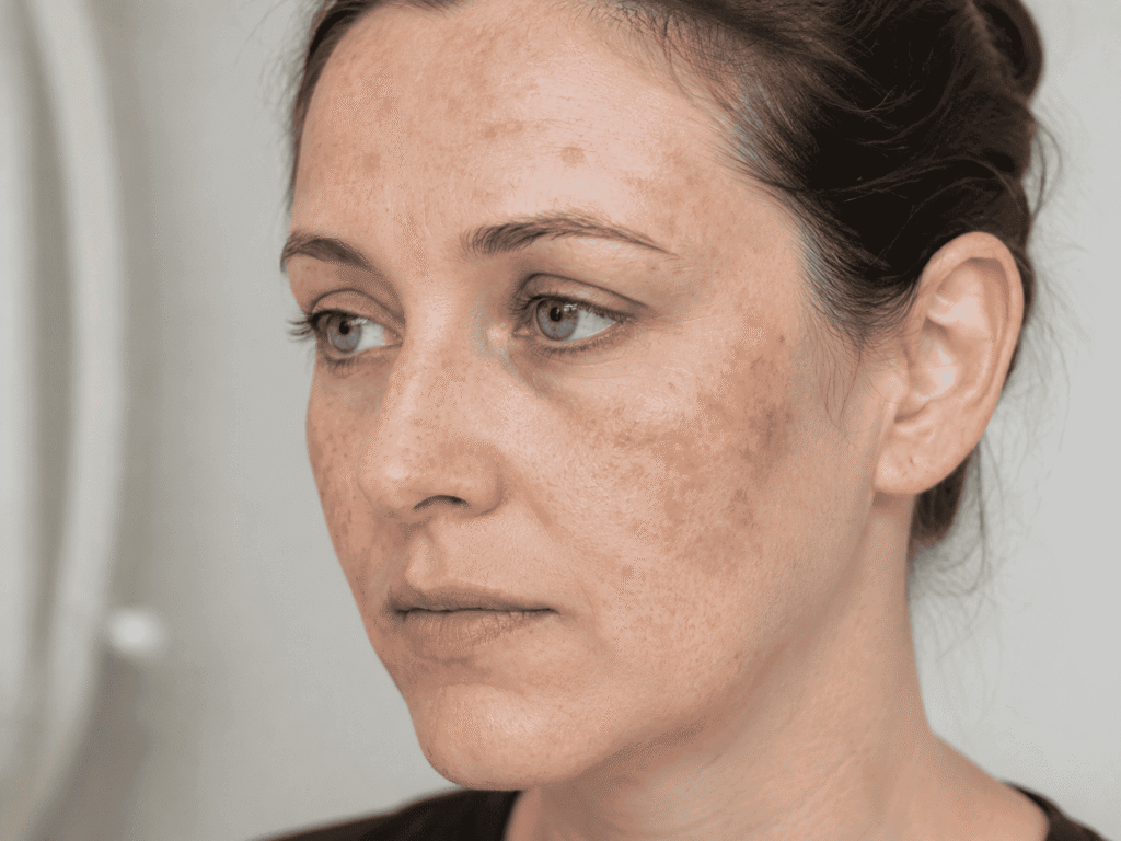 Melasma